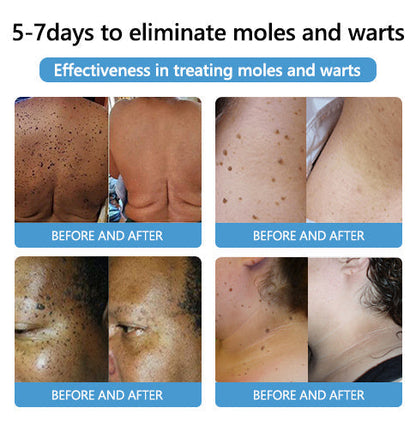 Acne Drying Lotion – Fights Inflamed & Pus-Filled Pimples Fast