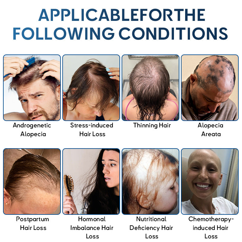 ✅🇺🇸 Developed by Trichologists：High-Concentration Minoxidil Hair Regrowth Serum