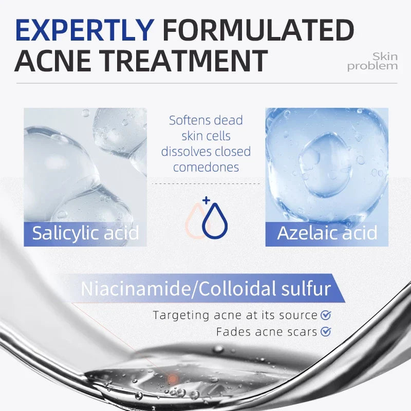 Acne Drying Lotion – Fights Inflamed & Pus-Filled Pimples Fast